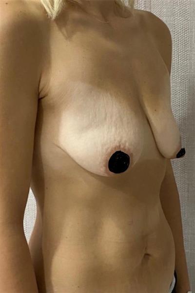 Breast Lift