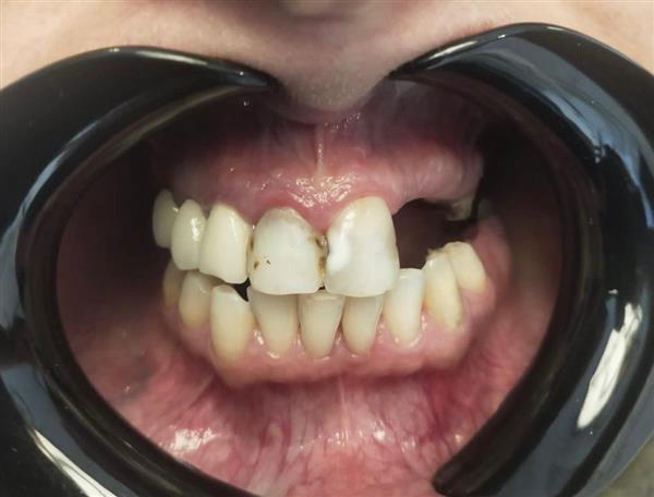 Porcelain Veneers