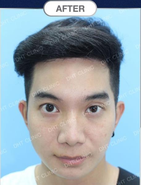 FUT Hair Transplant