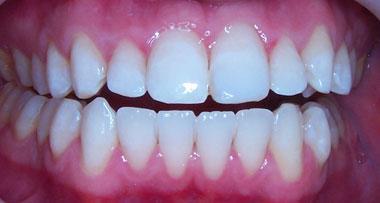 Teeth Whitening