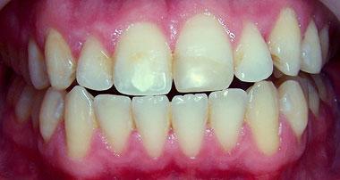 Teeth Whitening