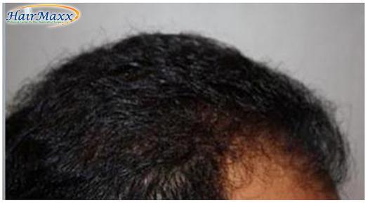 Hair Transplant