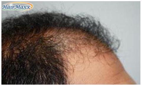 Hair Transplant